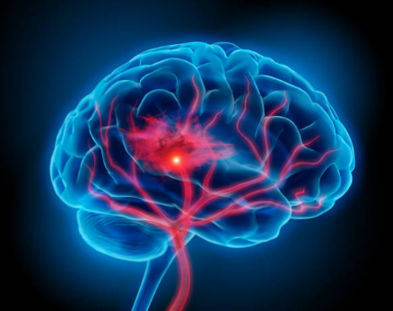 Stroke medical health insurance for less than $35 per week